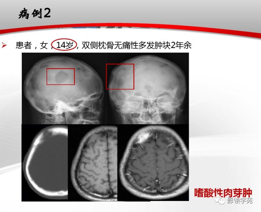 原发性颅骨肿瘤影像学表现