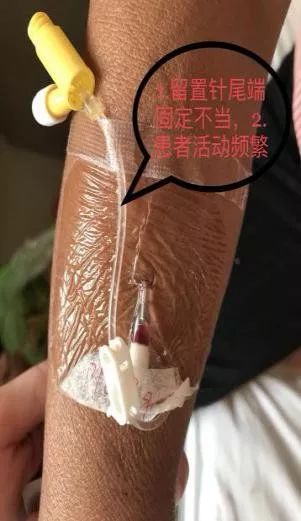 护士,我的留置针怎么又有回血了?