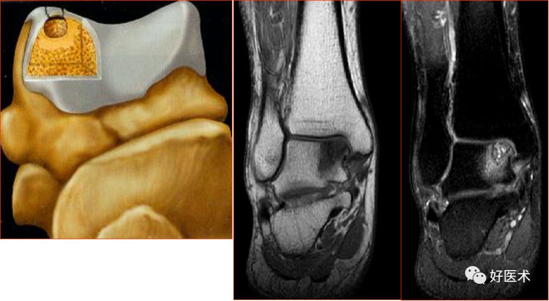 踝关节mri解剖与常见病变,都在这篇文章里!