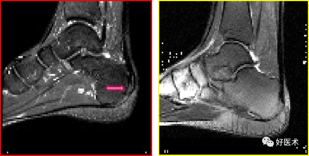 在t2wi脂肪抑制序列上可见低到中等异常信号 可伴有跟后滑囊炎 跟腱