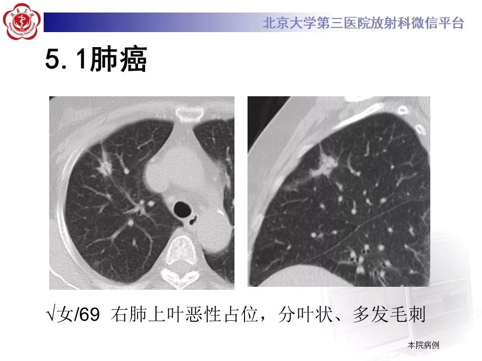 955】22岁女,间断咳嗽一年,后发现肺部占位1年