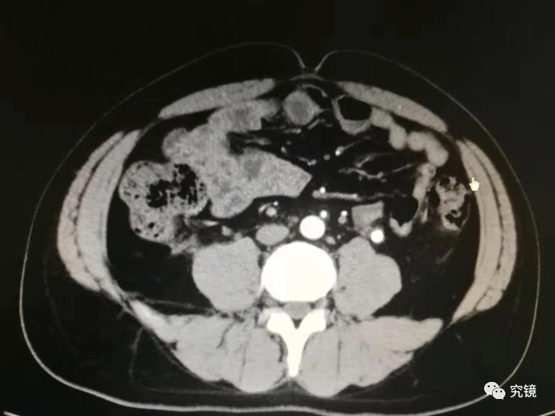 左肾积水怎么回事啊 791a3f9e8e97423b9fe2758634c04870.jpeg