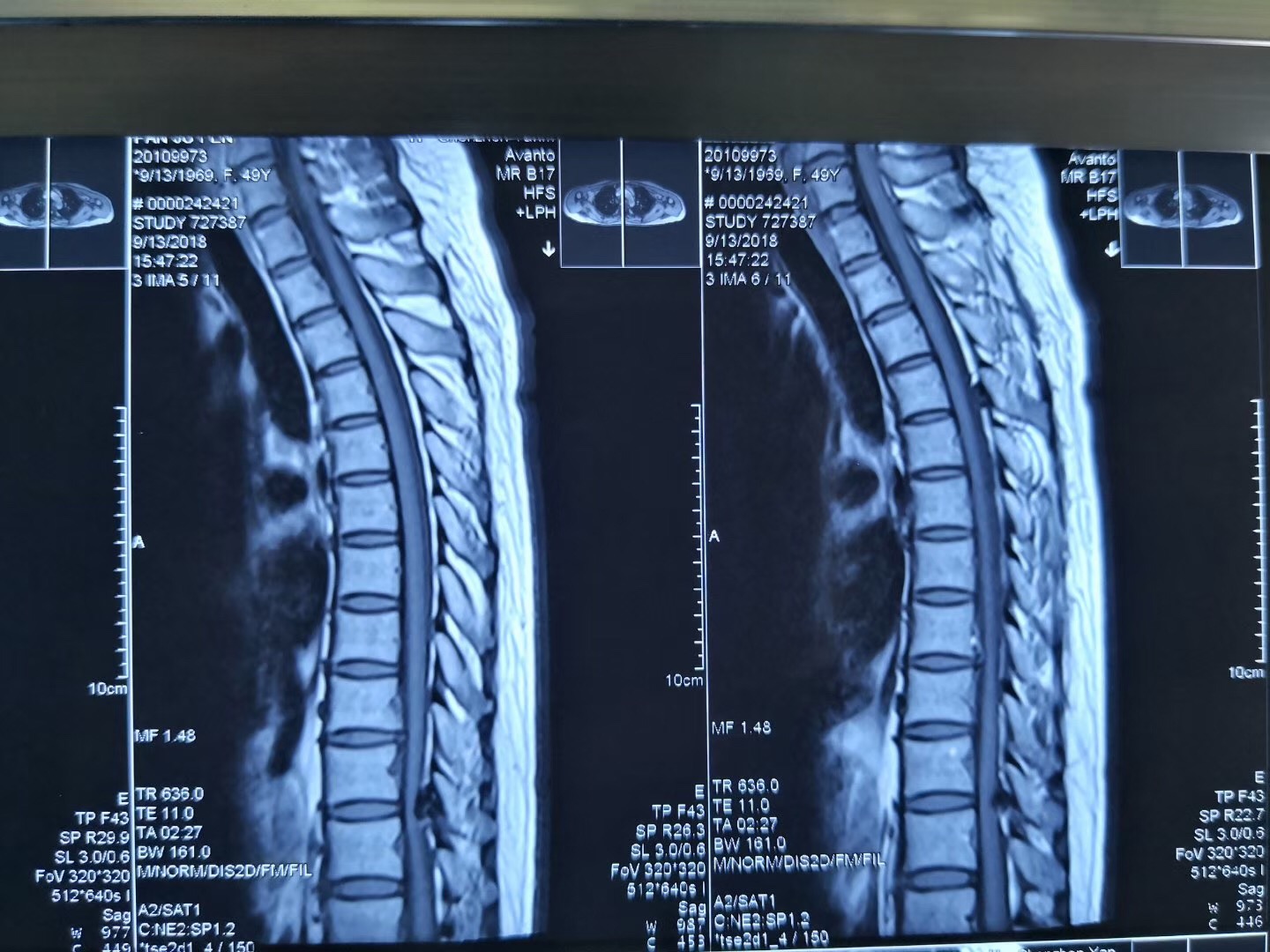 症 脊椎 管 狭窄 腰部脊椎管狭窄症患者の看護（原因・症状・看護計画・注意点）について