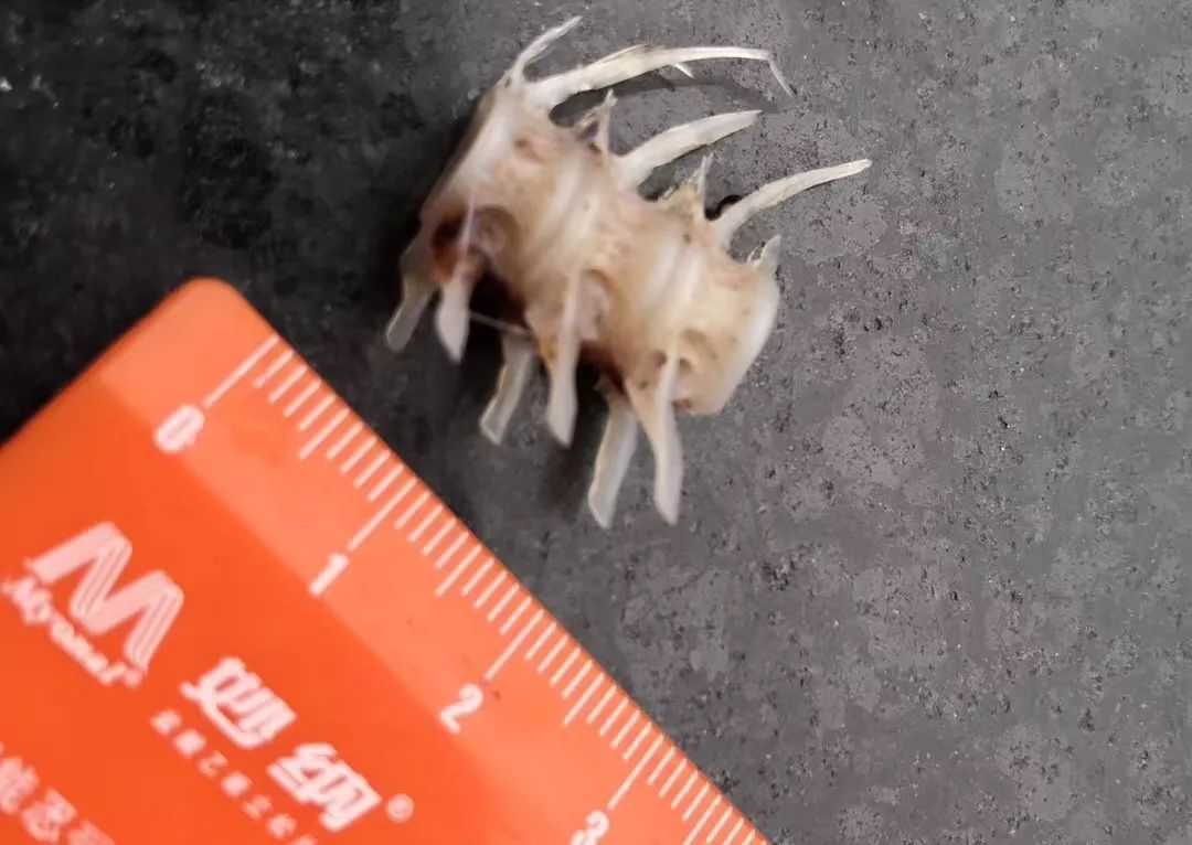 鱼刺卡喉咙,医生竟让病人吃手套,结果.