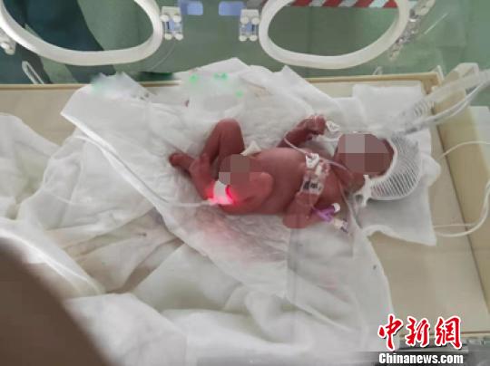 西藏早早产三胞胎“手掌宝宝”在拉萨获成功救治