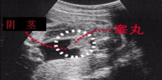 b超单上怎么看胎儿生殖图片
