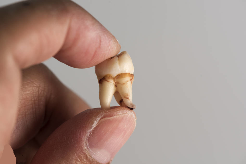 智齿在什么年纪会长出来 一般来说智齿会在14~30岁这个时间段里完全