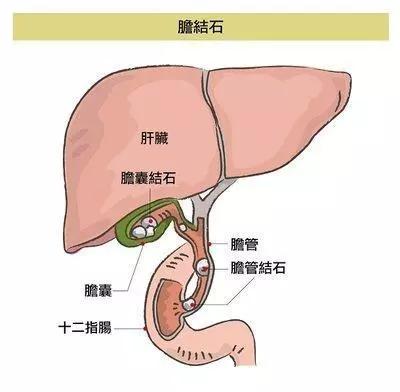 胆摘除的人口_胆摘除照片(2)