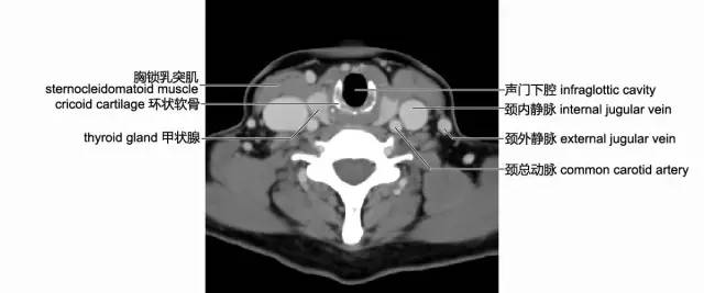 图4-3-5经环状软骨层面(ct增强)六,甲状腺峡部层面此层面约平第7颈椎