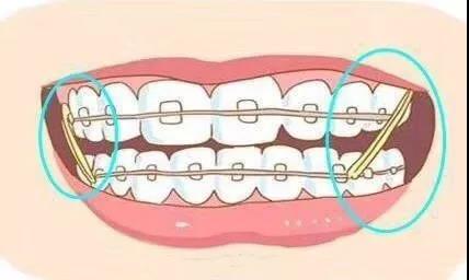 牙齿拥挤怎么办