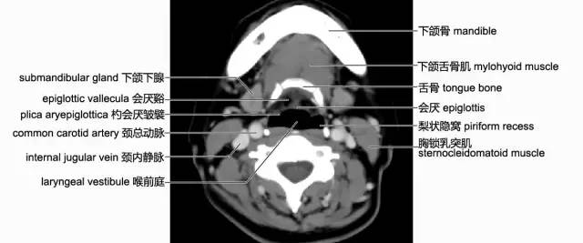 颈部影像解剖【收藏】_会厌