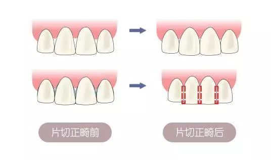 牙齿拥挤怎么办