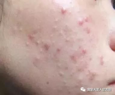 怎样快速止痒最快最有效 671165ea94514fb2885305bd6a89f187.jpeg