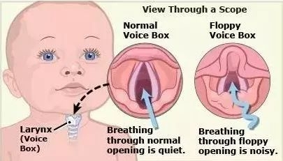 4个月大,呼吸或者吃奶的时候会发出呼噜呼噜的声音,大夫说是 喉管软化
