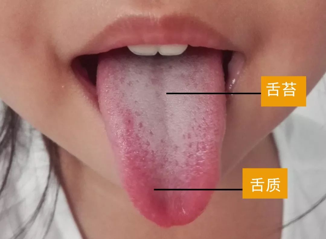 中醫舌苔 – 舌苔白厚原因 – Dinerpar