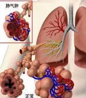 慢性支气管炎-慢阻肺-肺气肿(慢阻肺晚期-肺心病