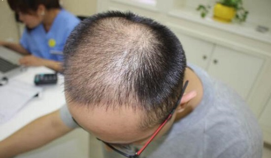 大量掉头发是怎么回事呢 9cf01380ebfb45238171132ba1dbb53d.jpeg