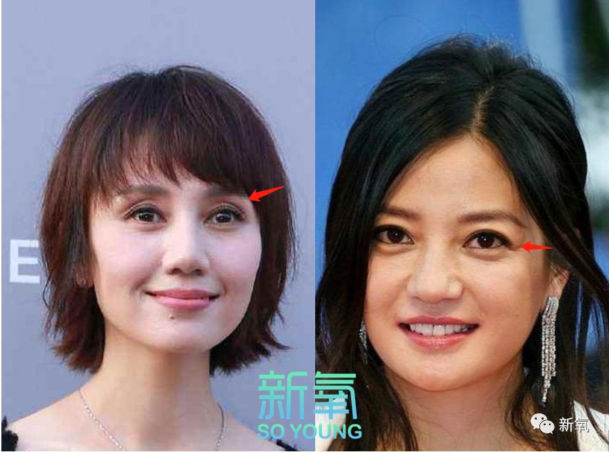 具体表现:袁泉的眼部是瘪,脂肪少导致眶睑沟出现的瘪,而赵薇是垂,眼皮