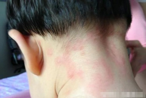 身上瘙痒怎么回事儿 ccc04979af30489eb56c7c46e337a7ae.jpeg