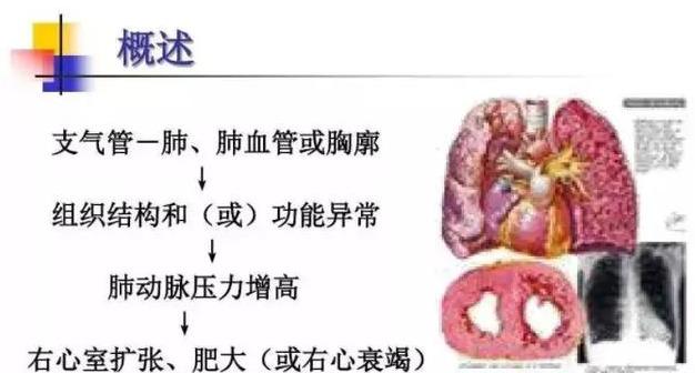 慢性支气管炎--慢阻肺--肺气肿(慢阻肺晚期)--肺心病