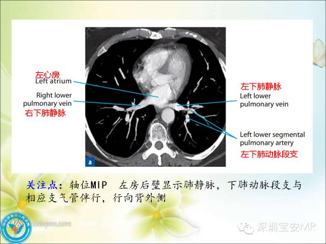 推荐丨肺动脉和肺静脉影像断层解剖