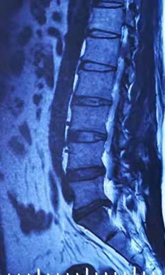 腰椎间盘突出的介入治疗是什么原理(3)