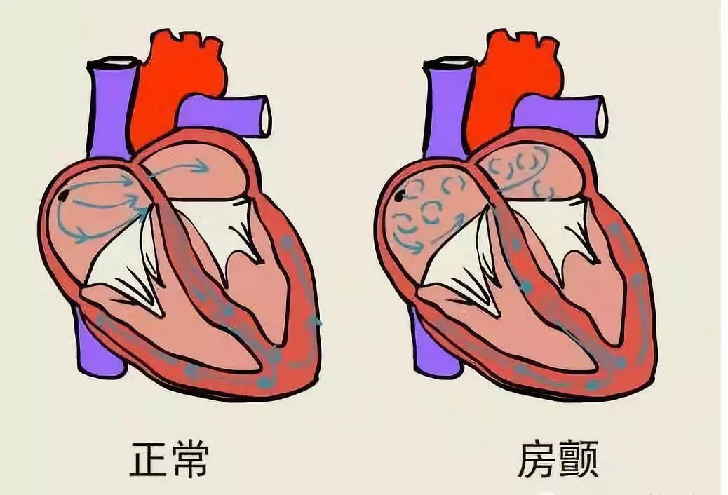 心血管专家分享"干货",五个"3"法,让你秒懂心脏慢性杀手:房颤