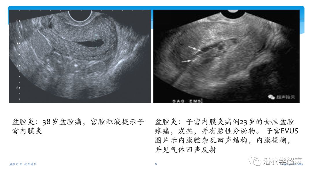 超声微课堂盆腔炎超声诊断