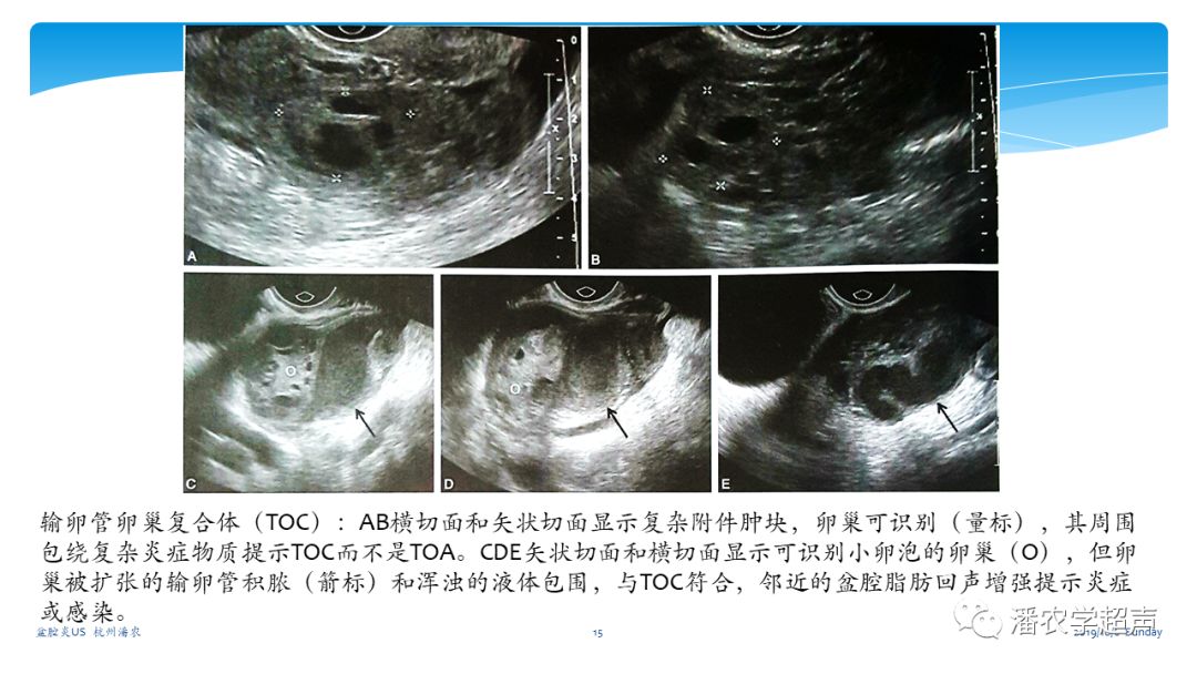 超声微课堂盆腔炎超声诊断