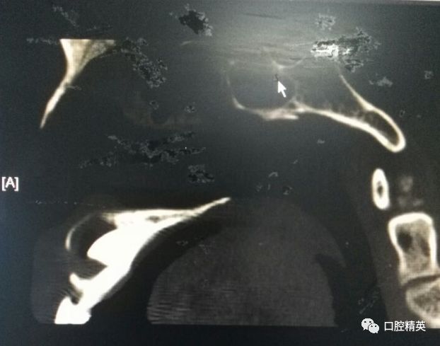 波及上颌窦腔的上颌含牙囊肿