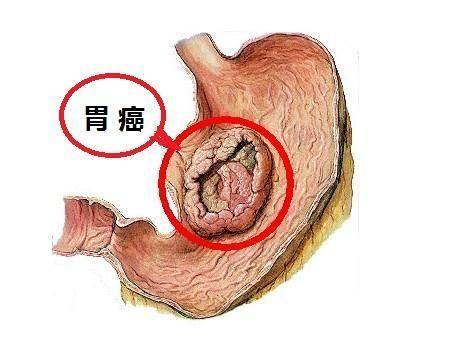 身上痛是癌症吗 644c7eb55a874110aaf46460ecc627cf.jpeg