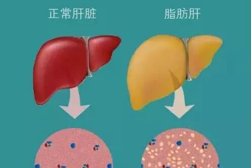 养肝就是养命,这两种植物能预防脂肪肝