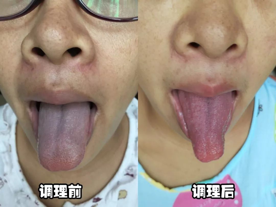 从这张图很明显的就可以看出调理前和调理后的差别了,舌苔的颜色和