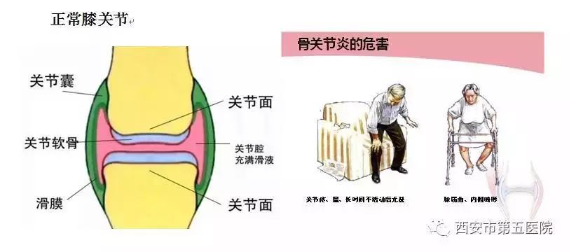 骨关节炎是一种以局灶性关节软骨退行性变,骨量丢失,关节边缘骨赘