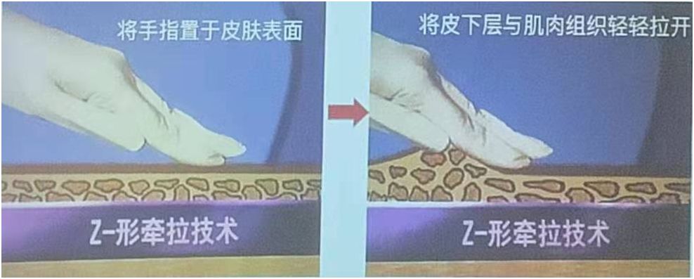 来看看这种z型注射法