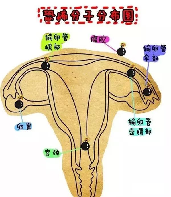 孕育科普宫外孕后还能正常怀孕吗