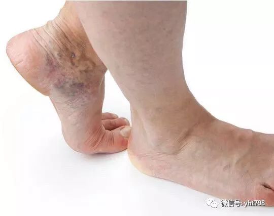 五个标志说明你血管狭窄，腿上有一个征兆，提示血栓正在进展期