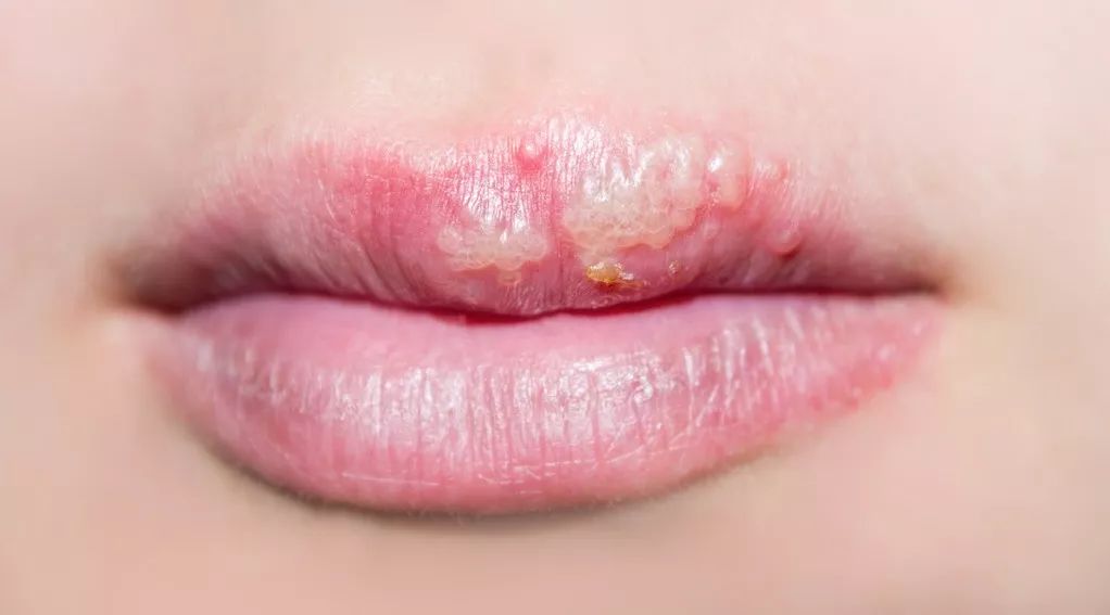 嘴唇长出泡泡比如这样:其实并不自知很多人感染了疱疹病毒这位宝宝就