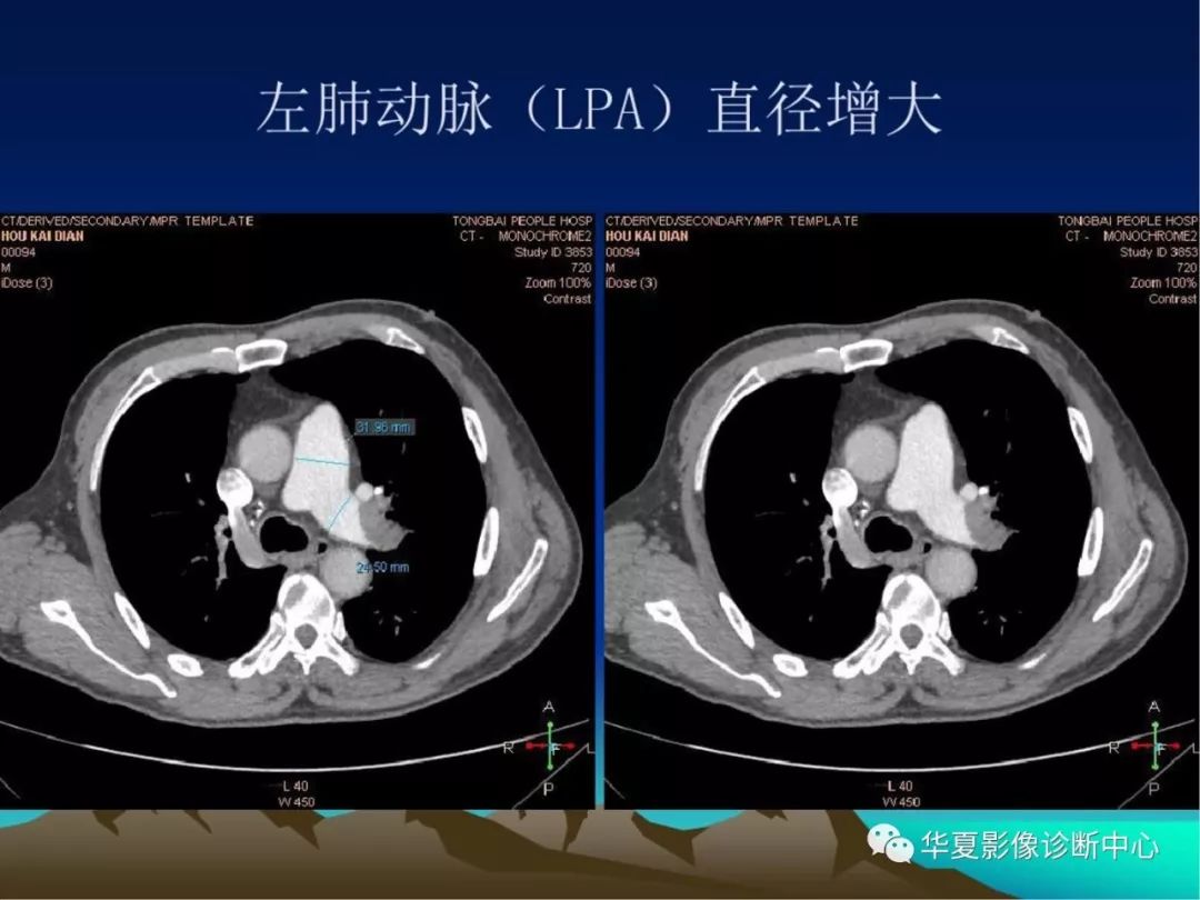 128层ct肺动脉造影诊断肺动脉栓塞