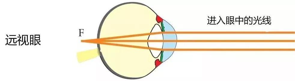 为什么近视不可逆,眼轴长度告诉你!