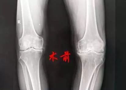 膝关节置换医院排名_膝关节置换图片(3)