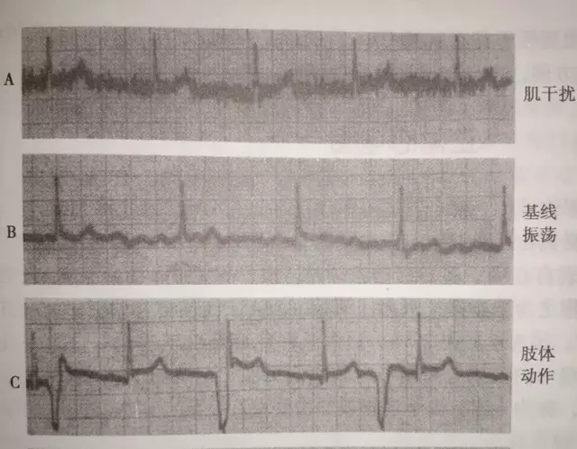 心电图伪差常见原因分析及解决对策