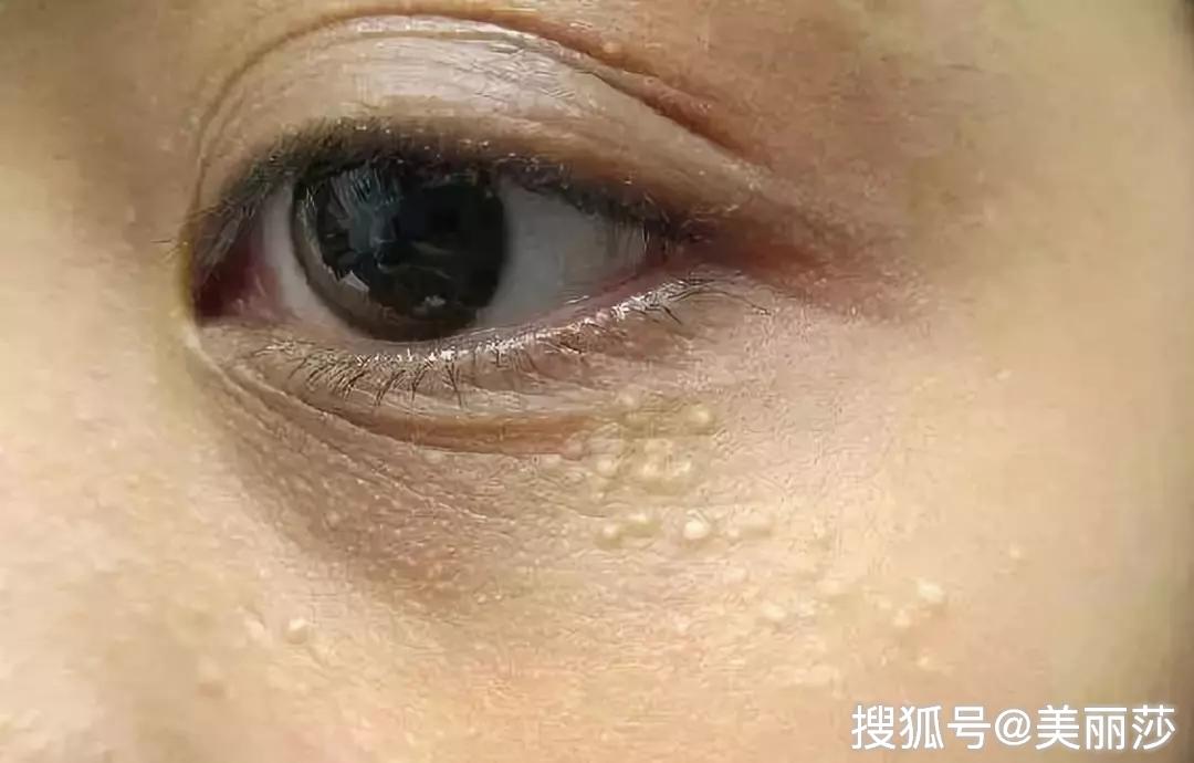 眼周小颗粒影响颜值,去除脂肪粒小妙招看这里!