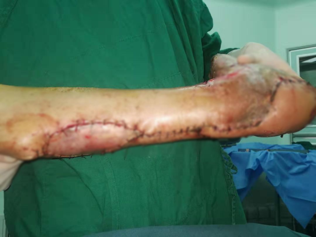 皮瓣及多种技术联合修复下肢,保肢成功.