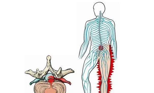 坐骨神经痛?针刀治疗效果好!