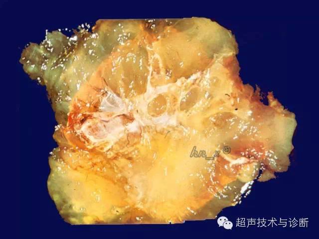 二维声像:声像上难以区别浆液性抑或粘液性囊腺癌,均表现为囊实性肿块