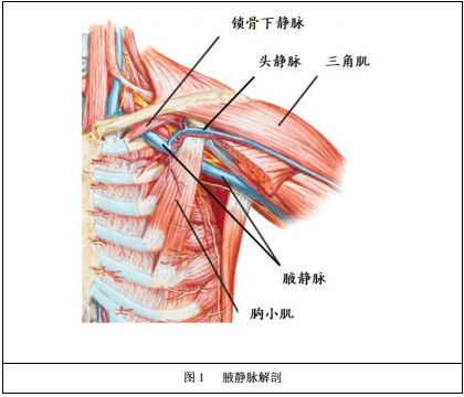 5!新的"盲法"腋静脉穿刺术_锁骨