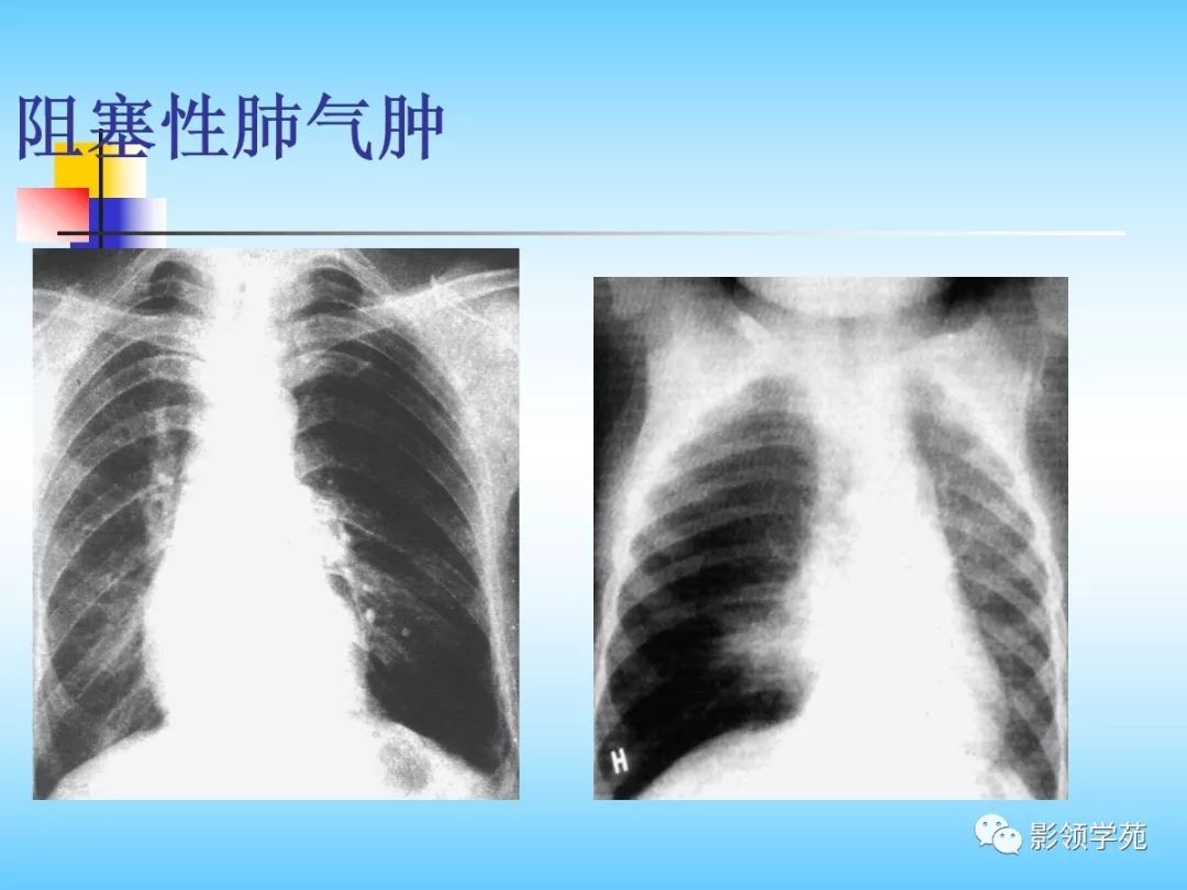 【清晰易懂】胸部正常影像学及基本病变