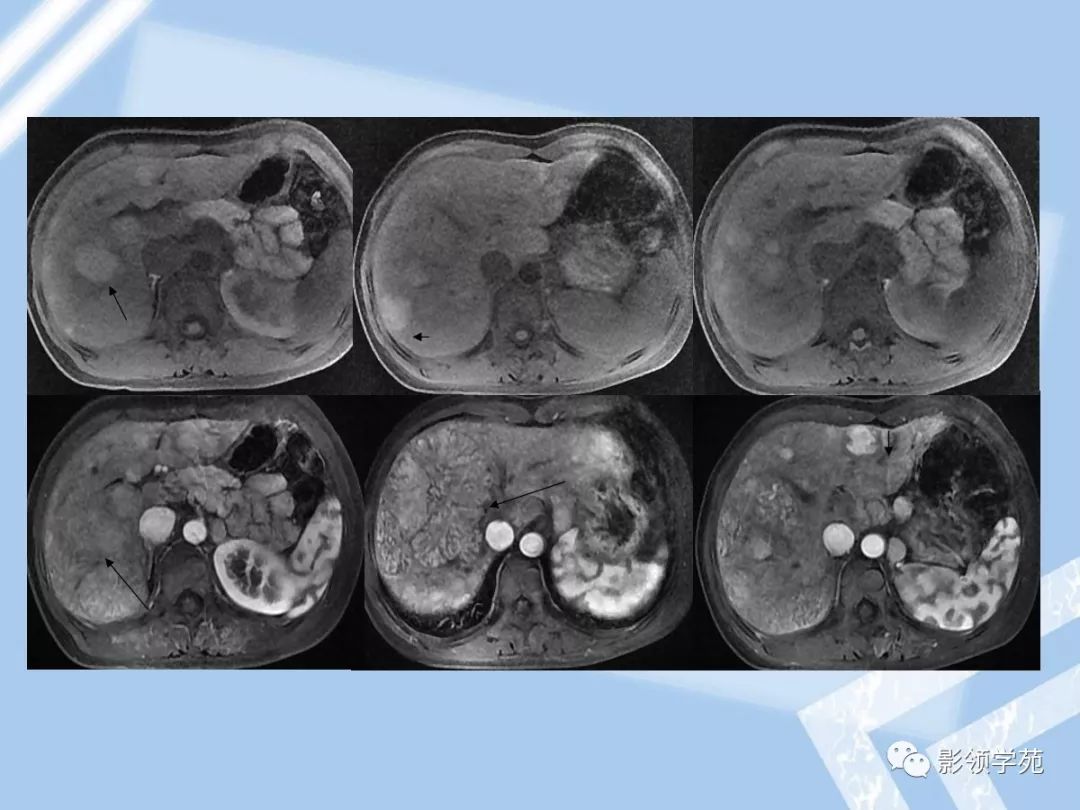 22种肝脏少见及不典型肿瘤的影像表现_门静脉