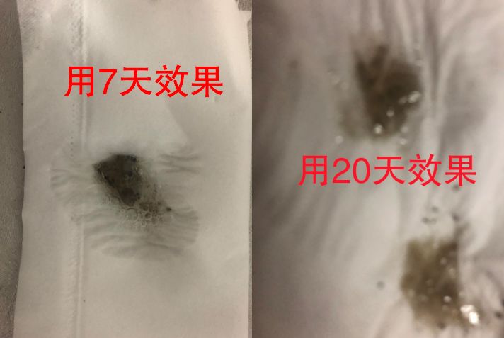 以痰或者尿的形式排出来把肺里的焦油,重金属,尼古丁都清掉变成白肺把